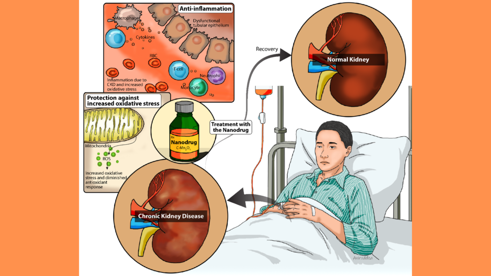 The Chronic Kidney Disease Solution Review: A Comprehensive Approach to Kidney Health The Chronic Kidney Disease Solution Review: A Comprehensive Approach to Kidney Health