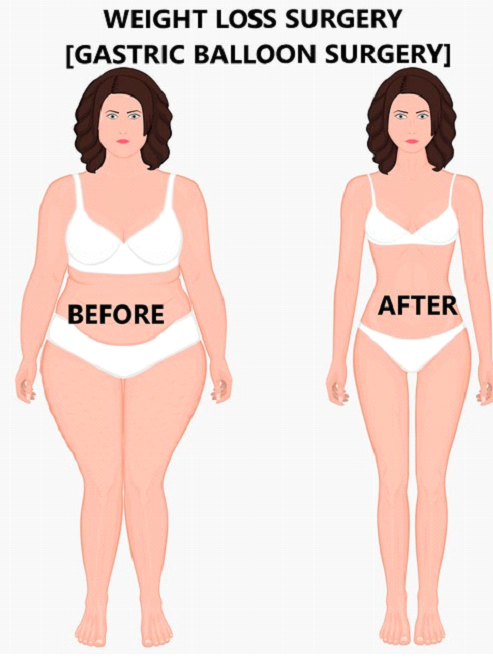 What weight loss surgery is covered by insurance? What weight loss surgery is covered by insurance?